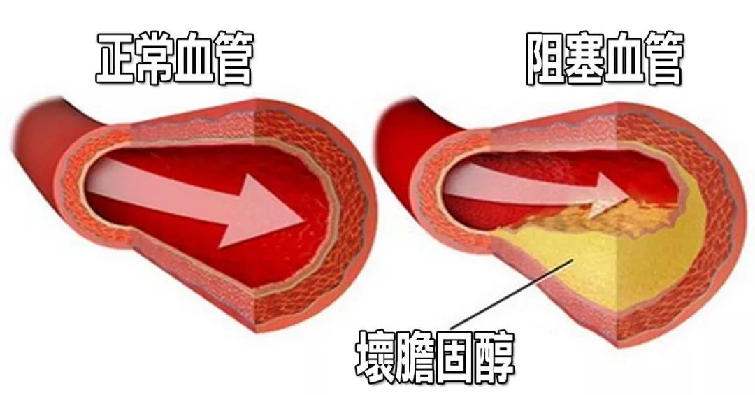 膽固醇血管.png