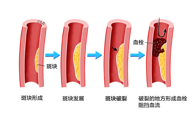 斑塊1.jpg